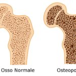 osteoporosi-cause immagine di repertorio